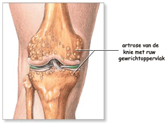 artrose van de knie
