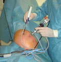 Artroscopie (kijkoperatie)